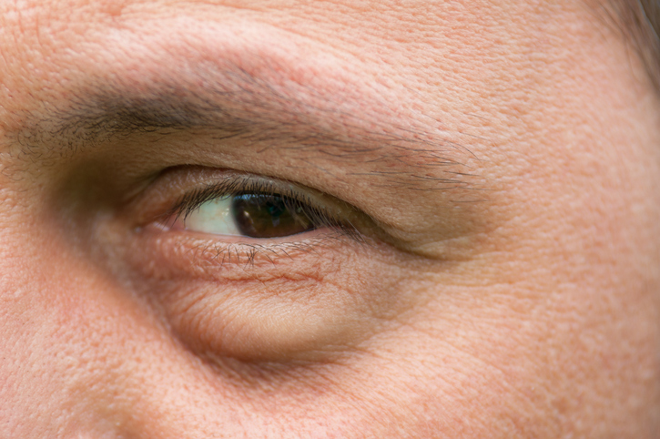 blepharoplasty recovery