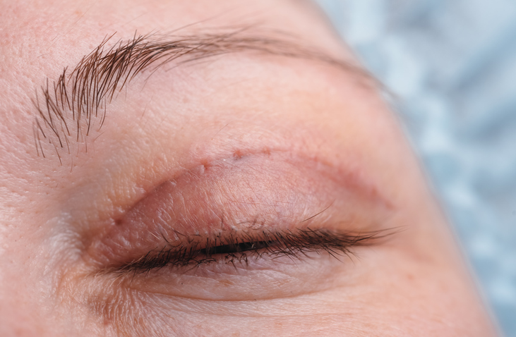 what is blepharoplasty eyelid surgery