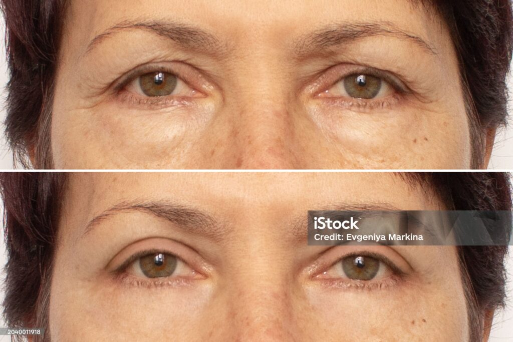 Upper + Lower Blephs